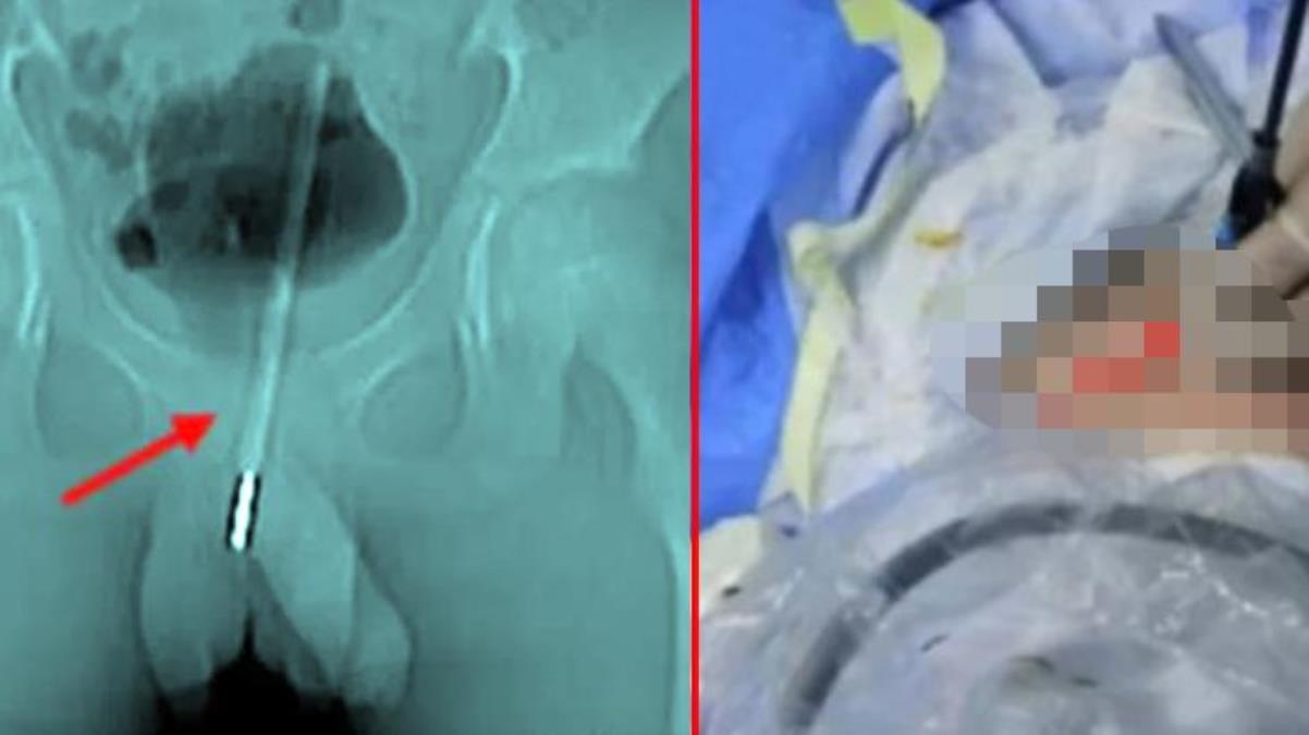 Küçük çocuğun mastürbasyon yapmak için cinsel organına soktuğu cisim doktorların ağzını açık bıraktı