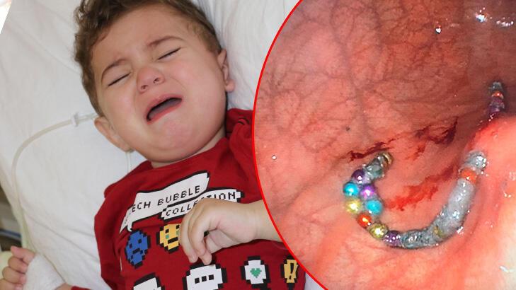 19 aylık Murat'ın midesinden 17 boncuk mıknatıs çıkarıldı