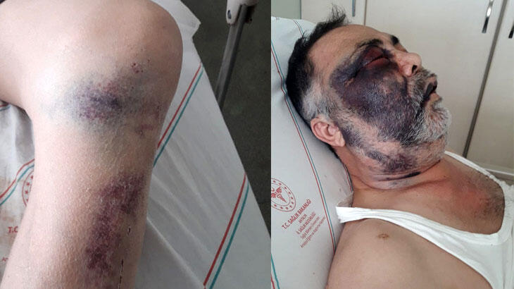 Antalya'da vahşet! Engelli adama öldüresiye dayak