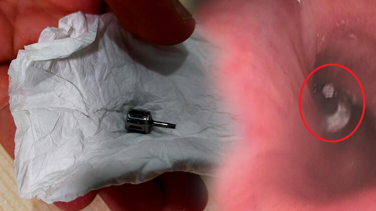 Dişçide akciğerine implant parçası kaçtı!