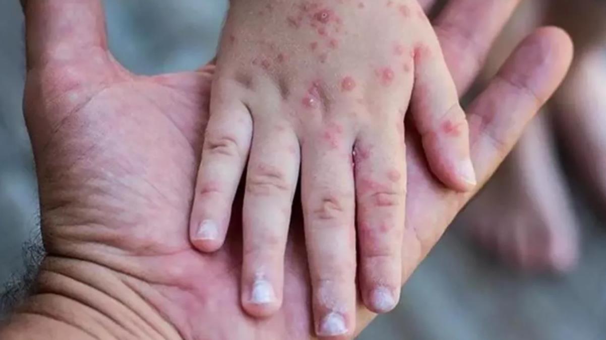 Dünyayı etkisi altına alan maymun çiçeği mutasyona mı uğradı? DSÖ'den merak edilen soruya yanıt 