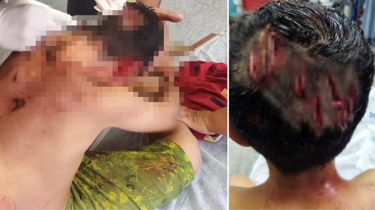 Gaziantep'te köpeğin saldırdığı çocuk ölümden döndü! Kafasına 25 dikiş atıldı