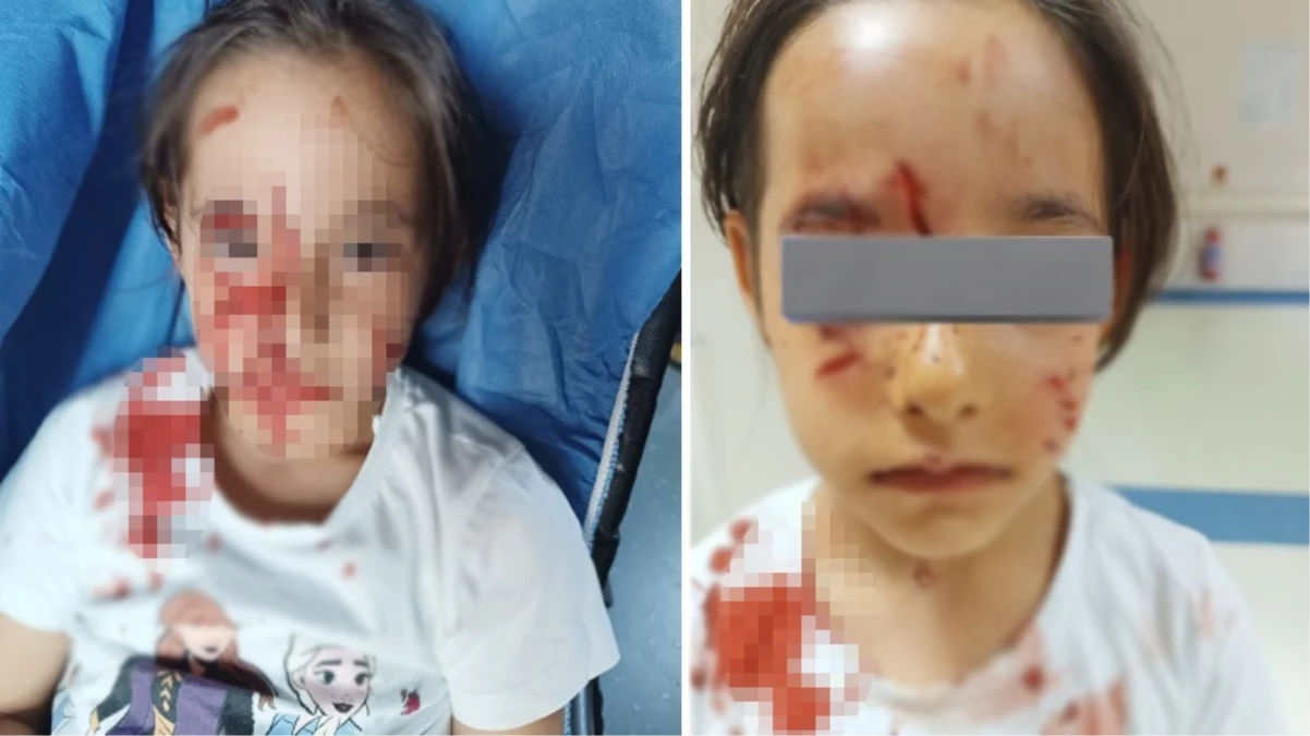 İstanbul'da başıboş sokak köpeği, 6 yaşındaki kız çocuğunun suratını parçaladı