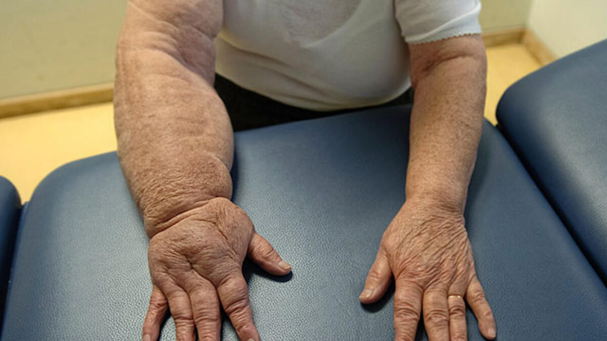 Kollarda ve bacaklarda oluşan şişlikler hangi hastalığın habercisi?