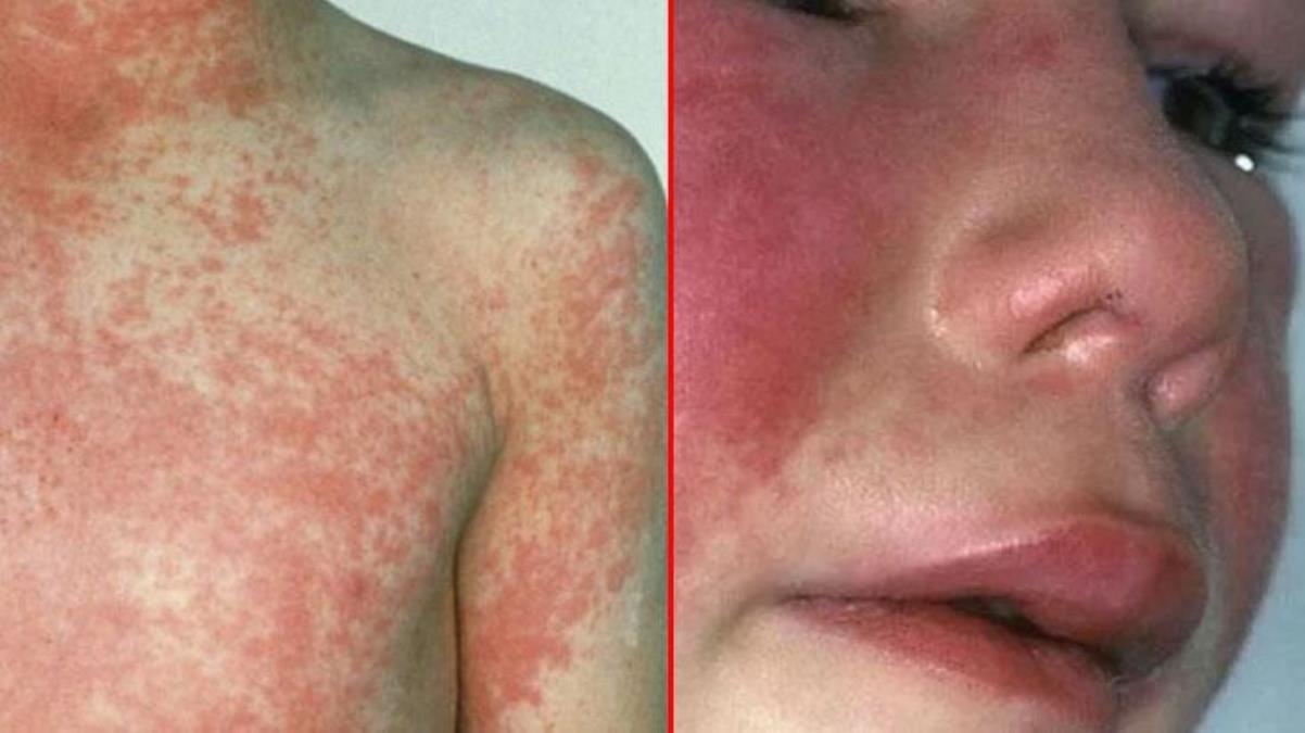 Korona bitmeden yeni kabus! İngiltere'nin başı yıllar sonra hortlayan ölümcül kızıl hastalığıyla büyük belada