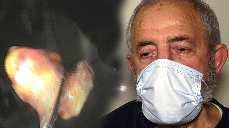 Koronavirüsten şüphelenildi, akciğerinden ceviz çıktı!