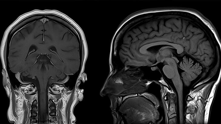 Kovid-19 beyni küçülttü: Kalıcı mı olacak yoksa geçici mi?