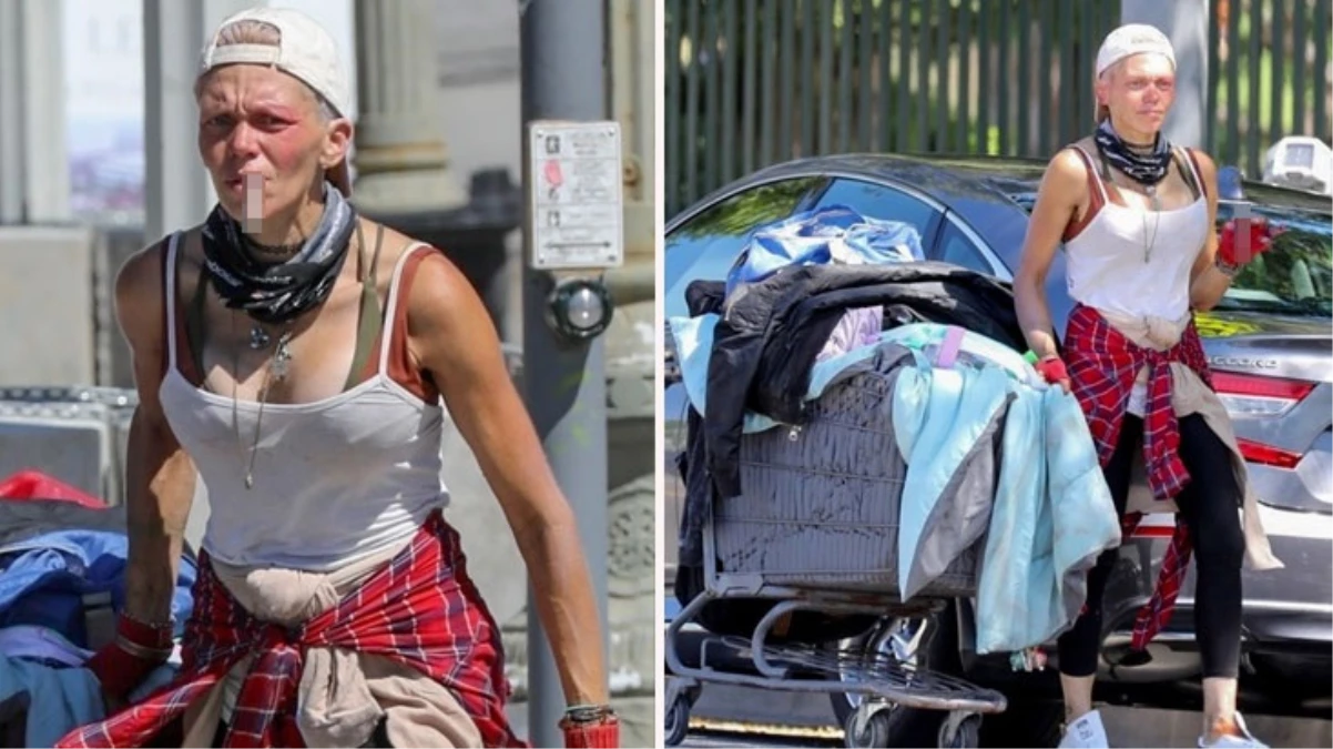 Sokaklarda yaşamaya başlayan model Loni Willison'ın yüzündeki morluklar endişelendirdi