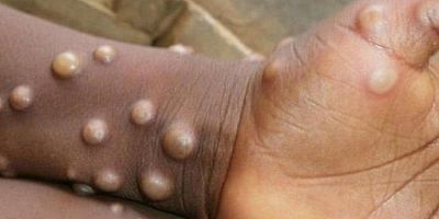 Maymun çiçeği virüsünde son durum! 'Cinsel ilişki' uyarısı geldi