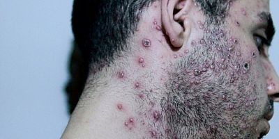 DSÖ'den 'maymun çiçeği' için acil durum ilan etti