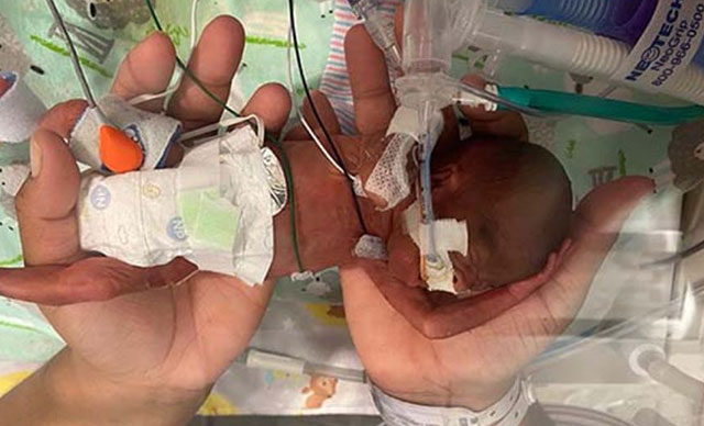 Dünyanın en erken doğan bebeği, rekorlar kitabına girdi
