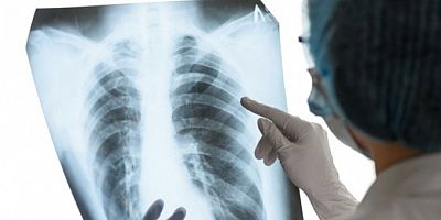 İşte akciğer kanserini tetikleyen en büyük etken!