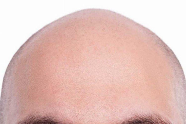 Hakimden şaşırtan karar: ‘Kel’ demek cinsel saldırı oldu