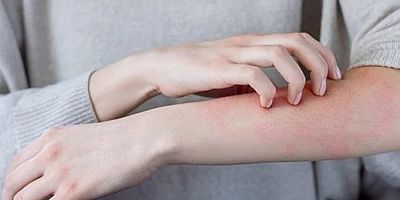 Uzmanlardan 'uyuz' uyarısı: Son yıllarda 3-4 kat arttı