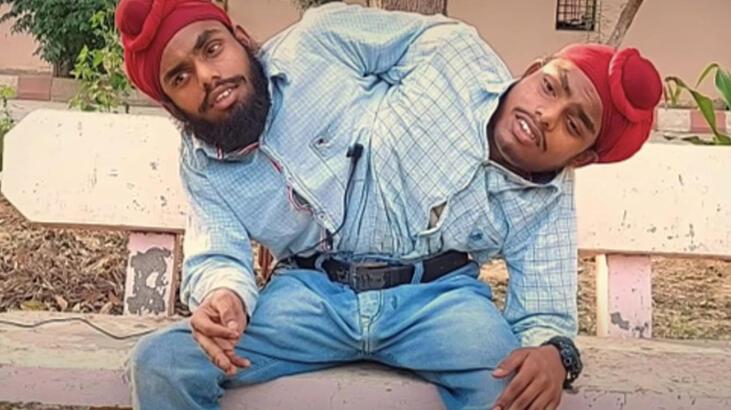 Yapışık ikizler iş buldu... Çift maaş alacaklar!