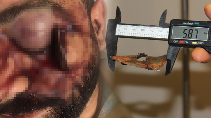 Yılbaşı eğlencesi kabusa döndü! Gözüne saplandı